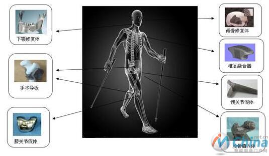 金属增材制造在生物医医疗行业的应用（来源于网络）