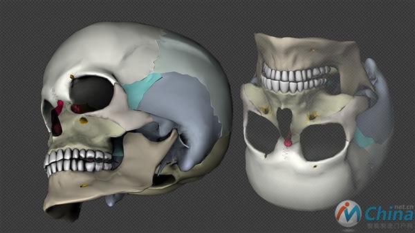 3D打印头骨